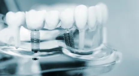 Implants dentaires & implantologie