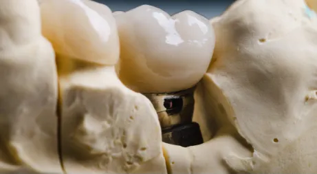 Greffes osseuses / r&eacute;g&eacute;n&eacute;ration